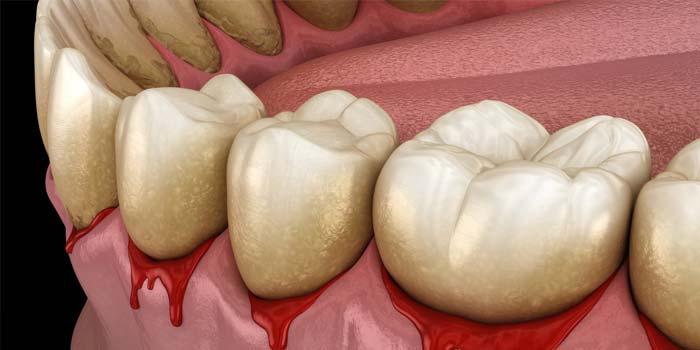 Online CPD - Clinical CPD Module 5 - Periodontal Disease CPD