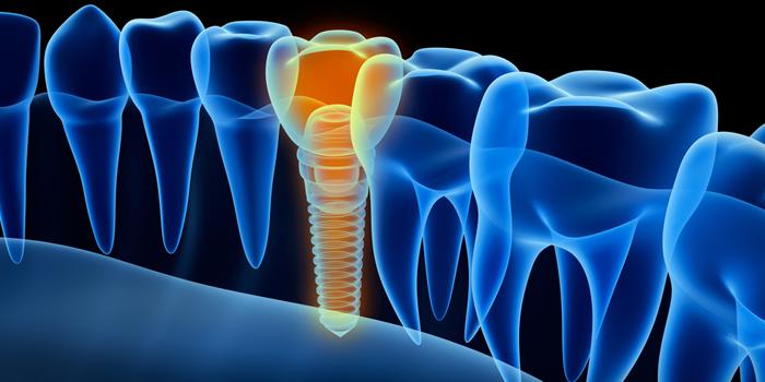 Online CPD - Clinical CPD Module 2 - Implants CPD